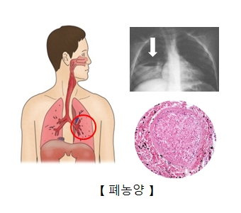 폐농양의 사진 및 폐농양으로 찍은 x-ray사진