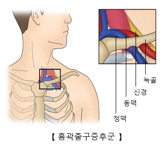 늑골 신경 동맥 정맥 위치등 흉곽출구증후군의 예시