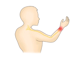 팔목에 발생된 흉곽출구 증후군의 예시