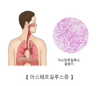 아스페르길루스곰팡이