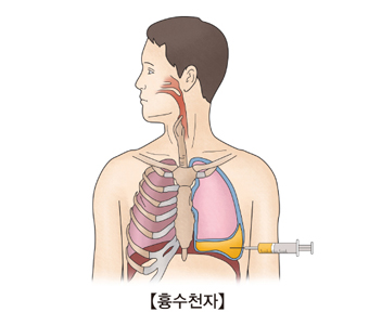 흉막삼출을 확인하기 위해 흉막액을 투입하는 남성