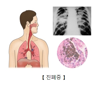 진폐증사진 및 진폐증으로 인해 가슴부분을 찍은 x-ray사진