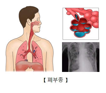 폐부종 x-ray사진 및 페부종 세포