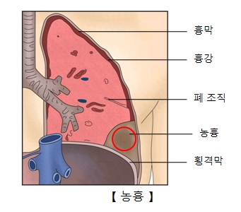 흉막 흉강 폐조직 농흉 횡격막 위치를 표시한 예시