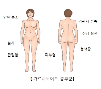 안면홍조 설사 관절염 피부염 청색증 신장질환 기관지수축등 카르시노이드 증후군의 예시