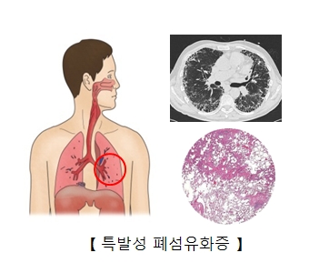 특발성 폐섬유화증으로 손상된 폐 사진 및 x-ray사진