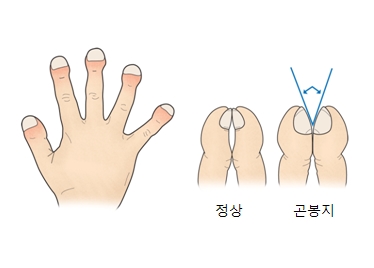 정상적인 손가락과 특발성 폐섬유화증인해 곤봉지가 발생한 손가락의 차이 예시 