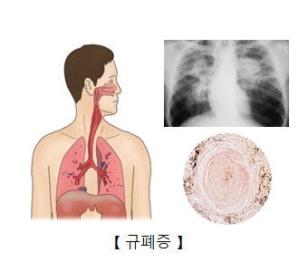 규폐증으로 인한 흉터사진 및 x-ray사진의 예시