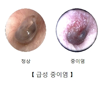 귀 내시경으로 본 정상적인 고막과 중이염에 걸린 고막의 모습