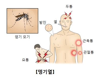 뎅기모기와 뎅기바이러스가 감염되었을때 나타나는증상 두통,열,발진,근육통,관절통,요통 