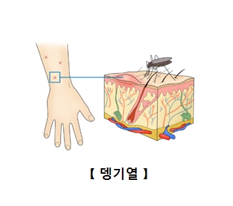 뎅기모기가 손목에 피를빨고있음