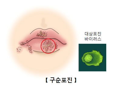 구순포진에감염된입술과 대상포진바이러스