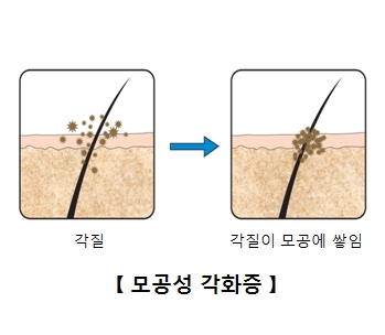 각질이 모공에 쌓여 모공성 각화증이 되는 원인을 예시