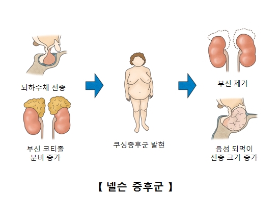 넬슨증후군-뇌하수체선종및부신코디졸분비증가로 쿠싱증후군발현-부신제거와음성되먹이 선종크기증가증세가 나타남