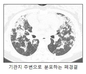 기관지 주변으로 분포한 폐경결의 예시