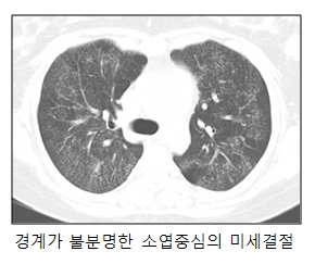 경계가 불분명한 소엽중심의 미세결절한 폐의 사진