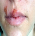 입술과 입주변에 발생한 염증