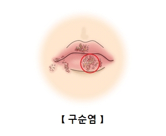 염증이 발생한 입술