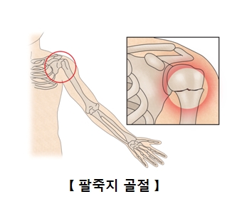 팔죽지가 골절된 인체해부도