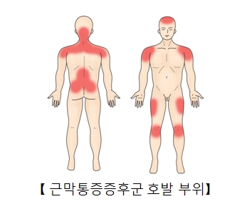 근근막 통증 증후군 | 질환백과 | 의료정보 | 건강정보 | 서울아산병원