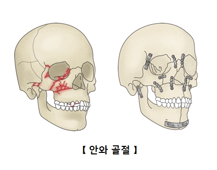 안와골절에 걸린 두개골 예시