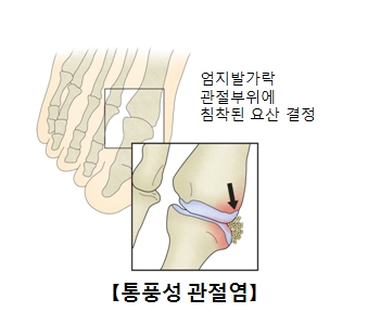 통풍성관전염으로 인해 엄지발가락 관절부위에 침착된 요산결정 사진