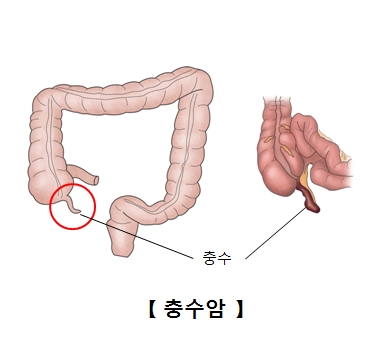 충수의 위치및 충수암의 예시