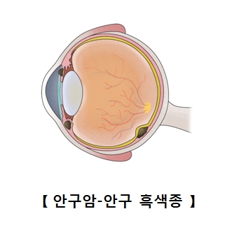 안구암 안구 흑색종의 예시