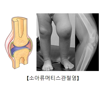 소아류머티스관절염에 걸린관절의 단면도와 실제아이의다리모습과 X-ray사진