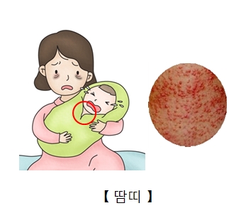 고온 다습한 환경에 노출되 땀띠가 형성되 괴로워하는 아이