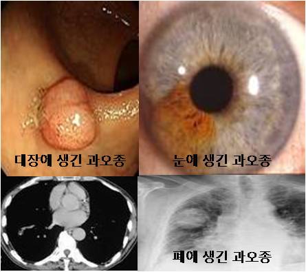 대장에 생긴 과오종 눈에 생긴 과오종 폐에 생긴 과오종의 예시