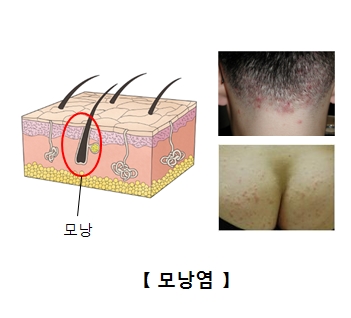 모낭의 위치와 머리 뒷편 및 엉덩이쪽 모낭의 예시