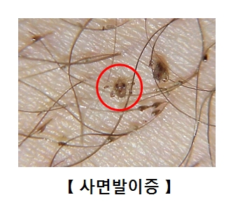 피부에 기생하고있는 사면발이