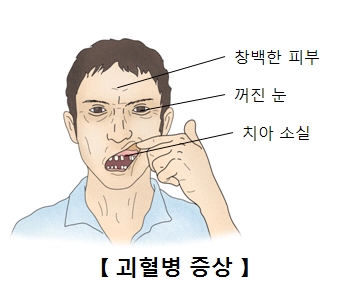 괴혈병증상 창백한피부,꺼진눈,치아소실