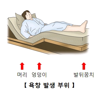 머리 엉덩이 발뒤꿈치에 발생되는 욕창 위치에 대한 예시