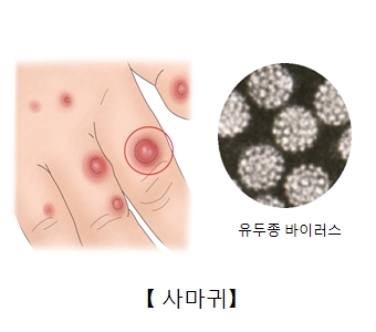 손가락 마디의 사마귀 예시 및 유두종 바이러스 