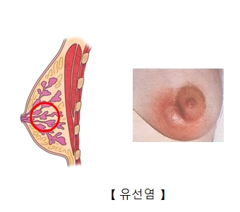 유선염-유방에 고름주머니가 생긴 사진 예시