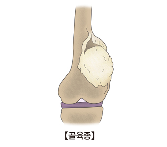 골육종 예시