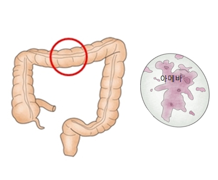 대장과아메바세균