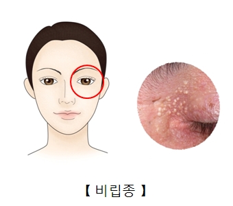 눈가 주변의 비립종의 모습 예시