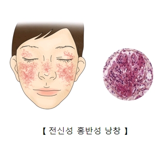 전신성 홍반성 낭창 예시