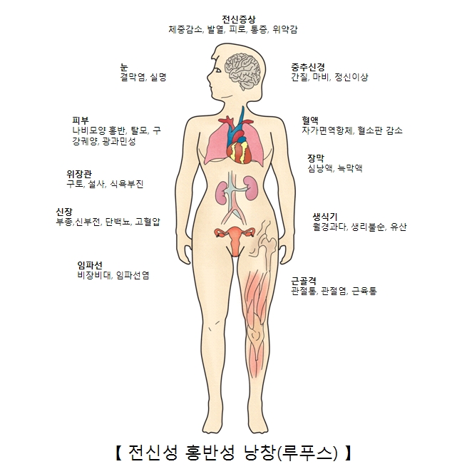 전신성 홍반성 낭창의 증상 전신증상(체중감소 발열 피로 통증 위악감) 눈(결막염 실명) 중추신경(간질 마비 정신이상) 피부(나비모양홍반 탈모 구강궤양 광과민성) 혈맥(자가면역항체 혈소판감소) 장막(심낭액 녹막액) 위장관(구토 설사 식욕부진) 신장(부종 신부전 단백뇨 고혈압) 생식기(월경과다 생리물순 유산) 임파선(비장비대 임파선염) 근골격(관절통 관절염 근육통)