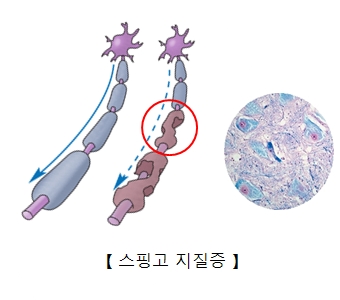 스핑고 지질증-정상 미엘린수초와 손상된 미엘린수초및확대사진 예시