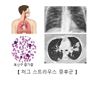 처그 스트라우스 증후군에 의한 x-ray사진 및 호산구 증가증 세포 이미지