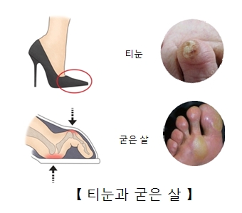 티눈및굳은살이 발생되는 원인과 실제 티눈과 굳은살의 예시