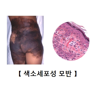 엉덩이 주변에 색소 세포성 모반이 발생한 모습 및 색소세포성 모반의 예시