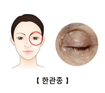 눈가 주변에 환관종의 모습을 예시