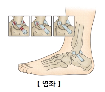 염좌의단계 1단계,2단계,3단계,발목사진예시