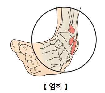 염좌에 걸린 발목 사진 