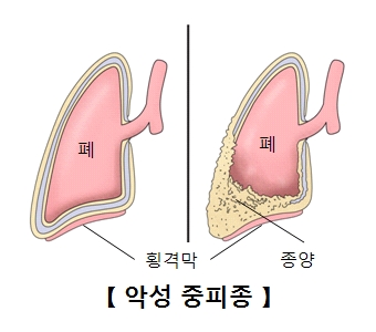 횡격막으로 둘러싸인 정상적인 폐의모습 종양으로 둘러싸인 악성중피종의 폐의 모습